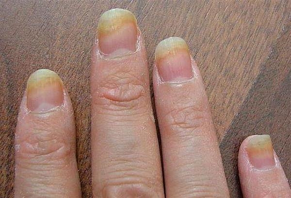 Лечение грибка ногтей в германии.
