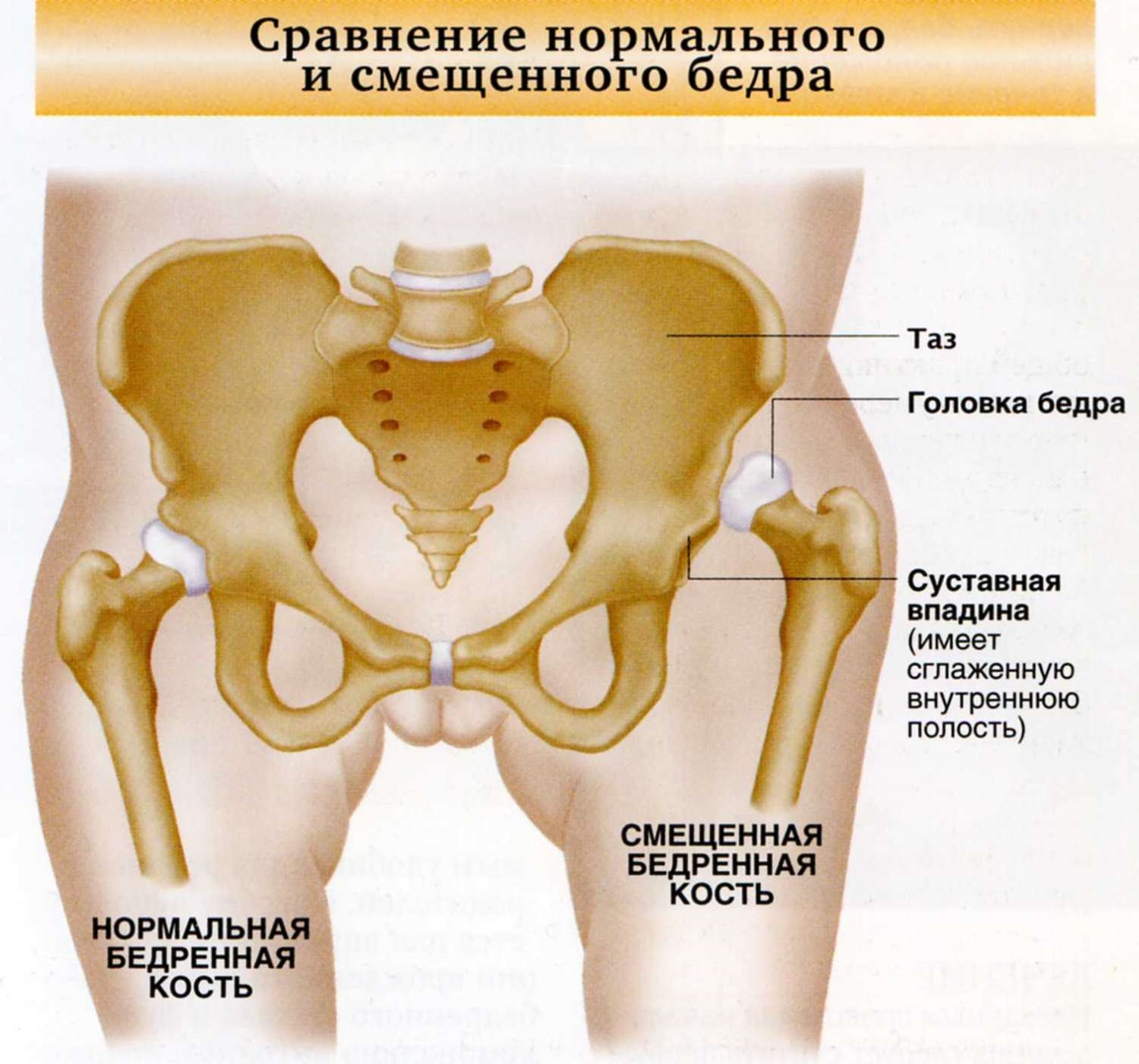 Подвздошная кость болит. Дисплазия вывих тазобедренного сустава. Врожденный вывих тазобедренного сустава. Подвздошная кость суставная впадина. Вывих и подвывих тазобедренного сустава.