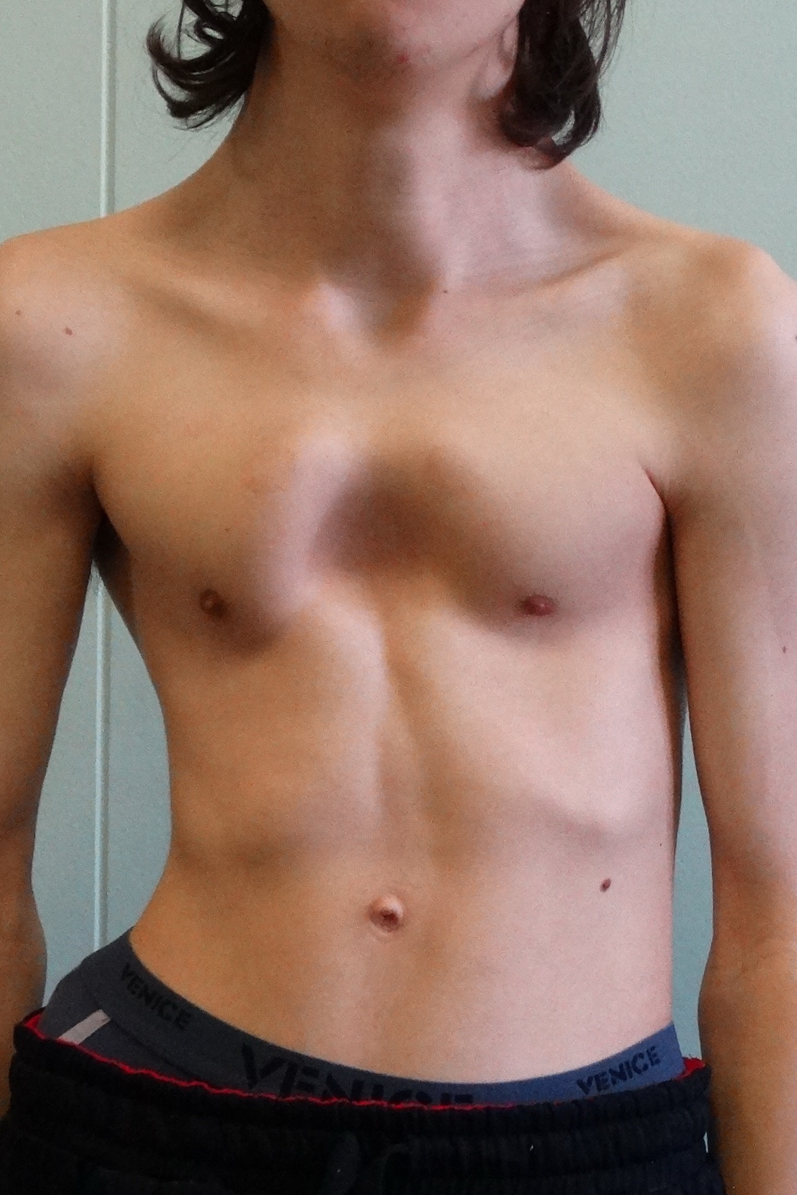 деформация груди у мужчин (120) фото