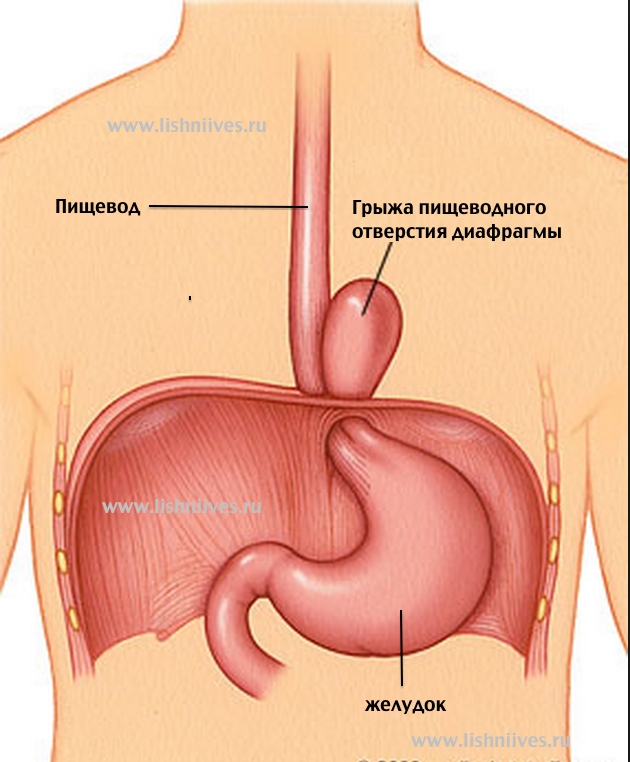 Грыжа под. Скользящая грыжа пищевода. Скользящая грыжа желудка. Эпигастральная грыжа желудка.