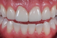 Зубы керамические: описание, особенности, изготовление и отзывы