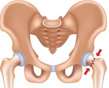 Тазобедренный сустав: перелом и его последствия. Эндопротезирование тазобедренного сустава, реабилитация после операции