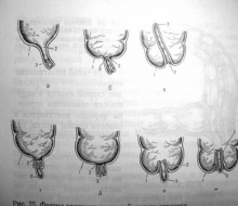 Редкие формы инвагинации кишечника у детей