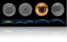 Что такое оптическая когерентная томография глаза?
