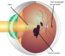 Ретинопатия и диабетическая ретинопатия
