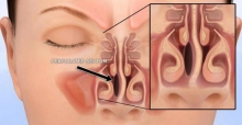 Перфорация носовой перегородки: причины, симптомы, методы лечения и последствия