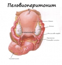 Народные методы лечения пельвиоперитонита