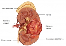 Рак почки Симптомы и причины болезни