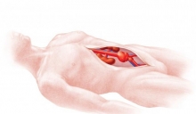 Аневризма брюшного отдела аорты: симптомы, диагностика, лечение