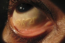 Какие бывают паразиты в глазах человека?