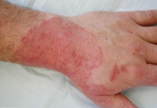 Микозы кожи: лечение препаратами и народными средствами, симптомы