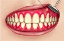 Периостит зуба: виды, причины, симптомы и лечение