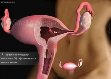 Полип матки и полип эндометрия
