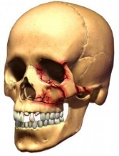 Переломы черепа: виды, симптомы, лечение и последствия