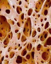 Резорбция - это разрушение костных тканей: причины развития патологии и методы диагностики