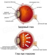 Глаукома - симптомы глаукомы, закрытоугольная и открытоугольная глаукома, диагностика, лечение