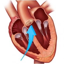 Замена аортального клапана: операция, возможные осложнения, отзывы