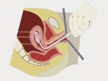 Выделения после биопсии шейки матки: норма и патология