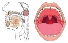 Рак горла гортани - симптомы и стадии заболевания, методы лечения рака гортани