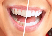 Система отбеливания зубов Global White: отзывы. Global White: плюсы и минусы