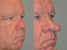 Ринофима носа: причины, симптомы, диагностика и особенности лечения