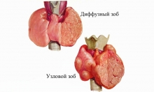 Народные методы лечения зоба
