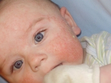 Аллергия у новорожденных и детей до года
