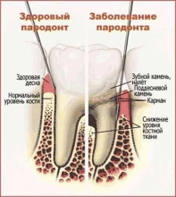 Народные методы лечения пародонтита