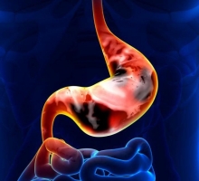 Перстневидноклеточный рак желудка: симптомы, прогноз и особенности лечения