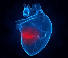 Обширный инфаркт: последствия, шансы выжить, реабилитация у мужчин и женщин