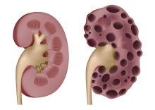 Поликистоз почек Лечение и диагностика