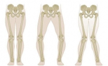 Вальгусная деформация коленных суставов: фото, причины, лечение