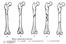 Особенности переломов у детей