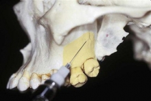 Туберальная анестезия в стоматологии: техника проведения, препараты