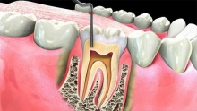 Пломбирование каналов зуба: методы и материалы