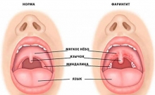 Кашель при фарингите. Чем лечить сухой и влажный кашель? Фарингит у детей: симптомы и лечение