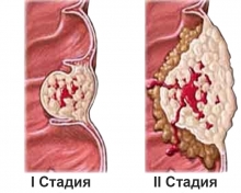 Рак щитовидной железы