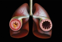 Бронхиальная астма: причины возникновения и методы лечения