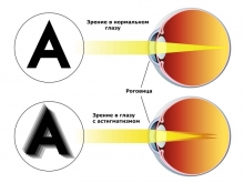 Астигматизм - симптомы патологии рефракции глаза, разновидности, особенности диагностики и лечения астигмат