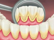 Зубные отложения: виды, причины и способы удаления