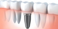 Зубная коронка на имплант: тонкости установки