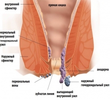 Геморрой - симптомы заболевания, основные признаки и стадии геморроя, внутренний и внешний геморрой, геморр