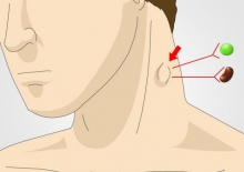 Опухли лимфоузлы на шее: возможные причины, симптомы и особенности лечения
