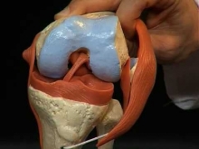 Лигаментоз коленного сустава: что это такое, причины появления и лечение