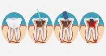 Депульпирование зуба: особенности процедуры, показания