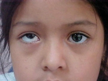 Как называется болезнь, когда глаза в разные стороны смотрят?