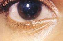 Бельмо - это помутнение роговицы глаза. Причины и лечение