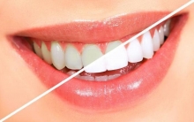 Ламинирование зубов: описание процедуры, отзывы