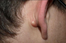 Жировик за ухом: причины появления и особенности лечения