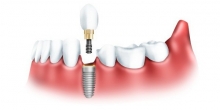 Виды имплантов зубов: описание, плюсы и минусы, фото